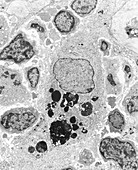 TEM of a macrophage from a human tumour