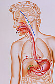 Artwork of vomiting mechanism in human body