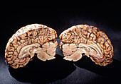 Healthy human brain cut in two (sagittal section)