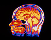 MRI scan of brain
