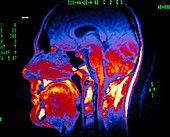 Normal NMR brain scan