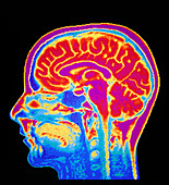 MRI scan of normal brain
