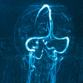 MRI scan of normal blood supply to brain