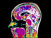 MRI scan of normal human brain in profile