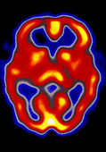 Coloured SPECT scan of a healthy brain