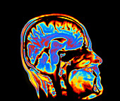 Coloured CT scan of the brain in head (side view)