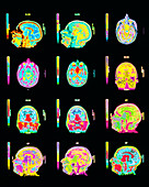 Coloured MRI scans of human brain (multiple views)