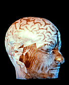 Coloured 3-D CT scan of a head with healt