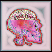 Coloured 3-D MRI scan of brain in CT scan of skull