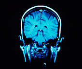 MRI scan of a coronal section through the brain