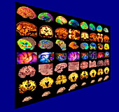 Human brain,coloured scans