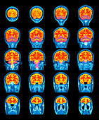 Healthy brain,MRI scans