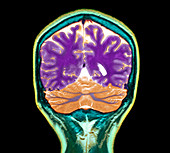 Healthy brain,MRI scan