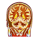 Healthy brain,MRI scan