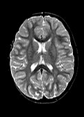 Child's brain,MRI scan