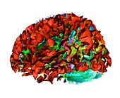 Advanced MRI brain scan