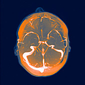 Brain blood vessels,MRA scan