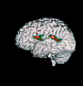 Colour PET brain scan showing verbal memory areas