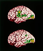 Colour PET brain scan when reading aloud/silently
