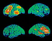 Colour PET scan of language areas of the brain