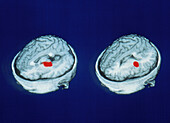 PET scans showing accurate word memory