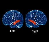 Brain hearing activity,PET scan