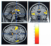 Tongue Display Unit research,MRI scan