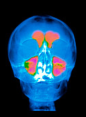 Coloured X-ray of a person's head & sinuses