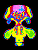 Coloured CT scan of nostrils and frontal sinuses