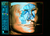 3-D CT scan of the head showing the sinuses