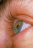 Close-up of an eye wearing a hard contact lens