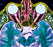 Vision and the brain,MRI scan