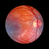Fundus camera image of a normal retina,Caucasian