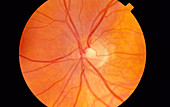 Healthy retina