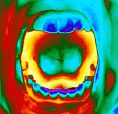 Thermogram of a woman's mouth and teeth