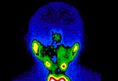 F/colour gamma scan of salivary and thyroid glands
