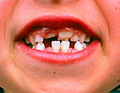 Girl's mouth showing replacement of milk teeth