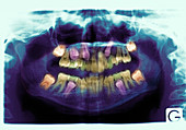 Emergence of adult teeth,X-ray