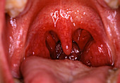 Inside of mouth showing normal throat & t