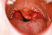 Healthy tonsils