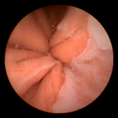 Stomach-oesophagus junction,pill camera