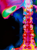 Gall bladder X-ray