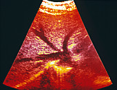 Coloured ultrasound of liver's hepatic arteries