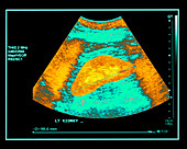 Healthy kidney measured,ultrasound scan