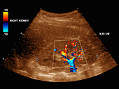 Healthy kidney,ultrasound scan