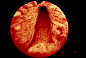 Endoscope image of the human urethra
