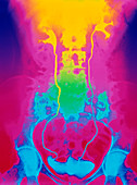 Urinary tract x-ray