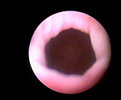 Urethral sphincter,endoscope view