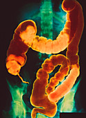 False colour X-ray of the colon after barium enema