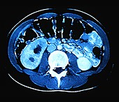 Healthy colon,CT scan